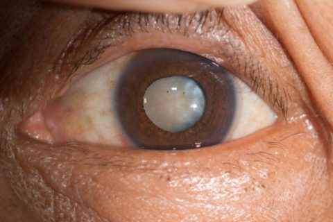 Cataract